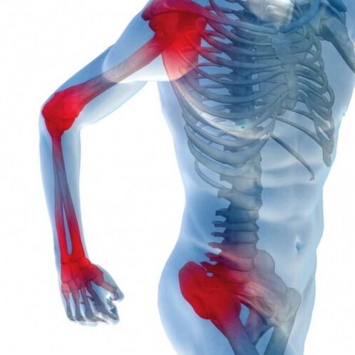 Bolesť kĺbov s rozvojom artritídy