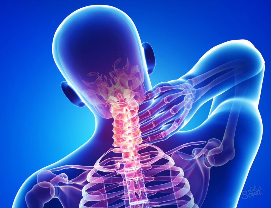 cervikálna osteochondróza