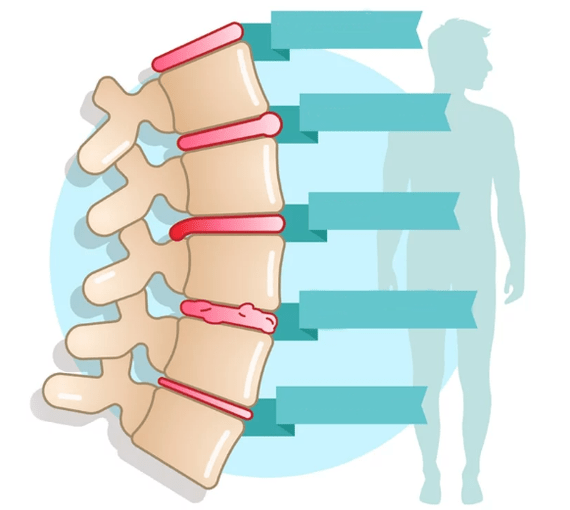 Stupeň ochorenia hrudnej osteochondrózy