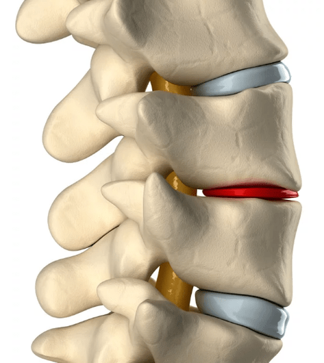 osteochondróza hrudnej chrbtice
