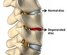 Normálny disk chrbtice, poškodený disk
