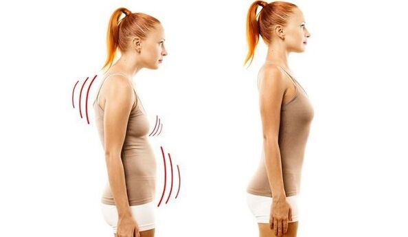 rovný chrbát a zlé držanie tela s cervikálnou osteochondrózou