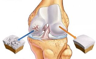 zdravá chrupavka a artróza kolenného kĺbu