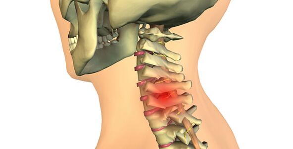 zmeny v chrbtici s cervikálnou osteochondrózou
