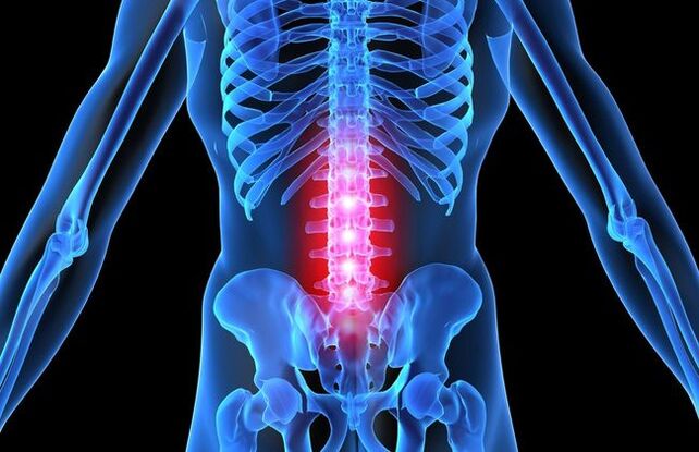 V pokročilom štádiu osteochondrózy bedrovej chrbtice sa motorická aktivita človeka zhoršuje. 